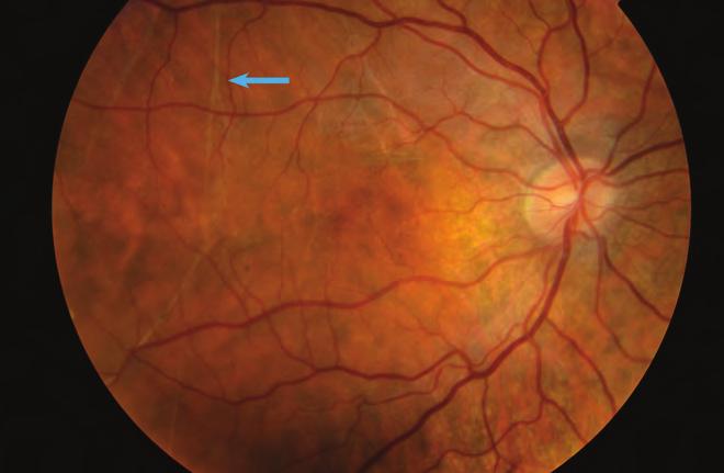 Evaluation and management of rhegmatogenous retinal detachment 9. ábra: A vékony, elágazódó köteg régi leválás jele (kék nyíl).