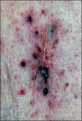 Metasztatikus melanoma