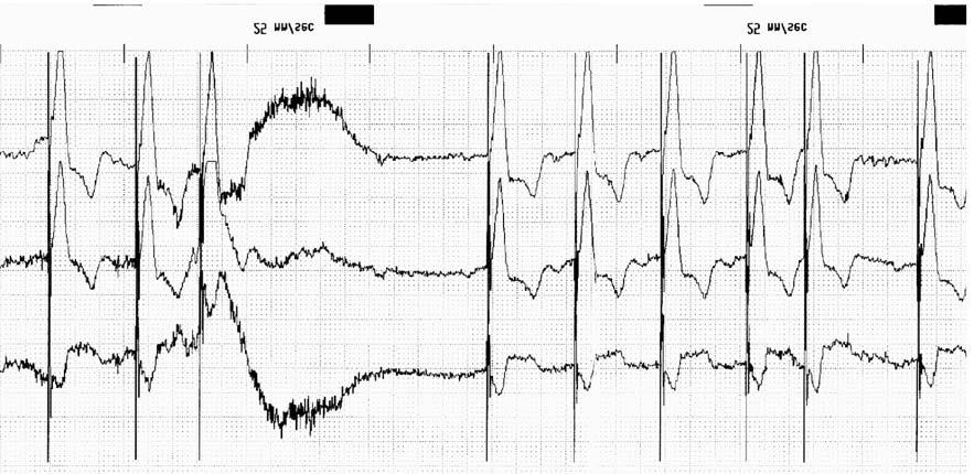 2. ábra Izompotenciál érzékelés: a pitvari elektródán történt érzékelés miatt gyorsabb mûködés (2. és 3.