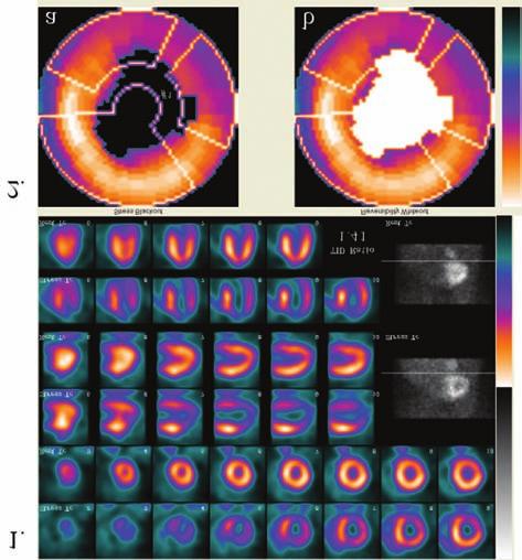 1. ábra High risk 3érbetegség, transiens ischaemiás dilatáció (TID: 1,41) 1. Terheléses myocardialis szcintigráfia SPECT 3 irányú metszeti képei (egymás alatt stress-rest sorrendben).