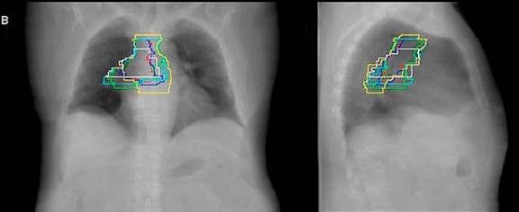 PORT CtRT: 2 x adjuvánskemoth. után min. 3 héttel: (50-) 56/2 Gykonform.