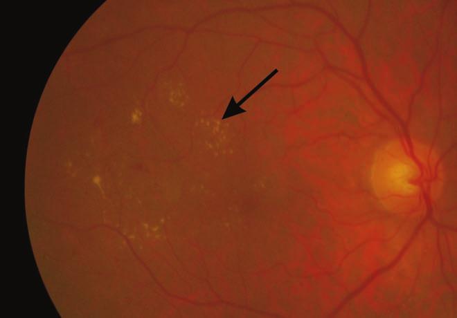 Current treatment of diabetic macular edema több mint 3500 személyt érintő reprezentatív felmérés alapján a diabéteszes retinopathia/maculopathia prevalenciája 20% volt (78).