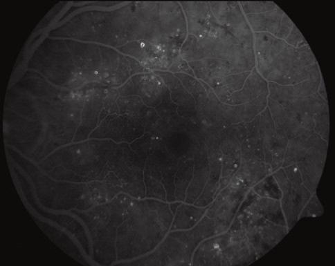 Előrehaladottabb esetekben biomikroszkópiás vizsgálattal is igazolható ezen patológia. Trakciós ödéma esetén a sebészi kezelés (vitrectomia) segítheti a funkció javulását.