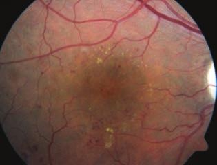 Current treatment of diabetic macular edema 4.