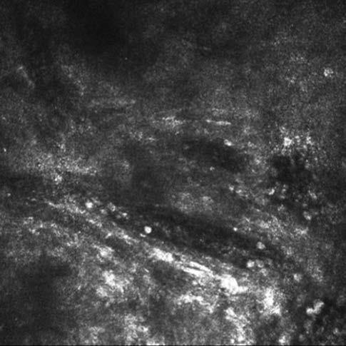 Examination of cornea using confocal microscopy 2.
