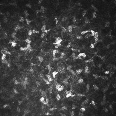 A szaruhártya vizsgálata konfokális mikroszkóppal 5. ábra: Elülső stromában lévő ke ra - tocyták (hrt3/rcm, 400 400 µm, z=76 µm) 6.