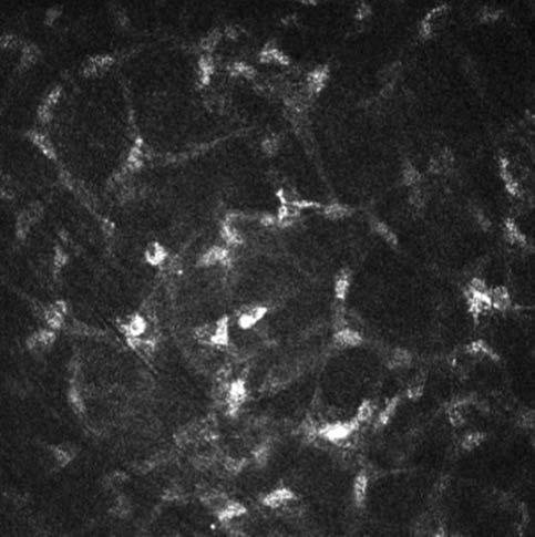 Kontaktlencse-viselőkben a Langerhans-sejtek sűrűsége szignifikáns eltérést mutat, mind a centrum (CD=78±25 sejt/mm 2 ), mind pedig a cornea perifériás részein (CD=210±24 sejt/mm 2 ) (8).