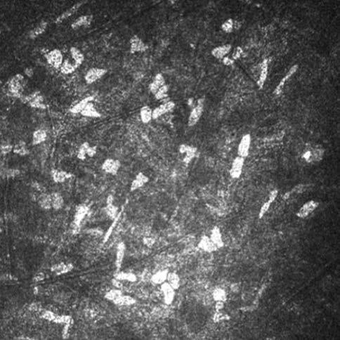 Examination of cornea using confocal microscopy 7. ábra: hátulsó stromában lévő ke - ra tocyták (hrt3/rcm, 400 400 µm, z=495 µm) 8.