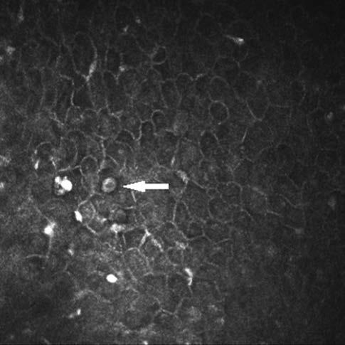A szaruhártya vizsgálata konfokális mikroszkóppal 10. a b ábra: Acanthamoeba ciszták (hrt3/rcm, 400 400 µm, z=18 µm) a b jeleznek (4, 16).