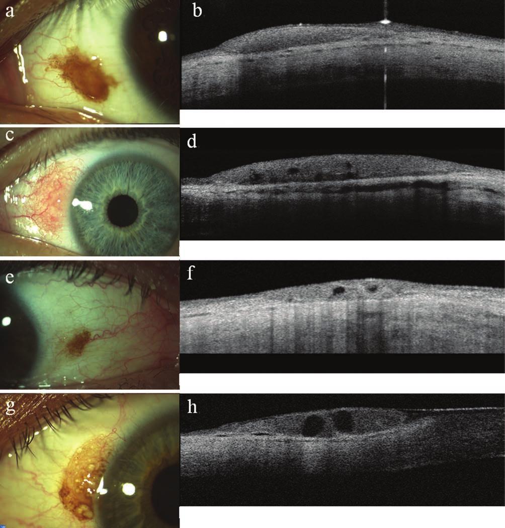 diagnosis of conjunctival nevi Bevezetés A conjunctiva naevusok a leggyakrabban előforduló szemfelszíni be - nig nus tumorok, bár a pontos inci - dencia nem ismert (21).