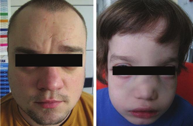 Camurati-Engelmann s disease with ocular symptoms 1. ábra: Arcfotó Camurati Engelmann-betegség (A, B) A kes járás, fáradékonyság.