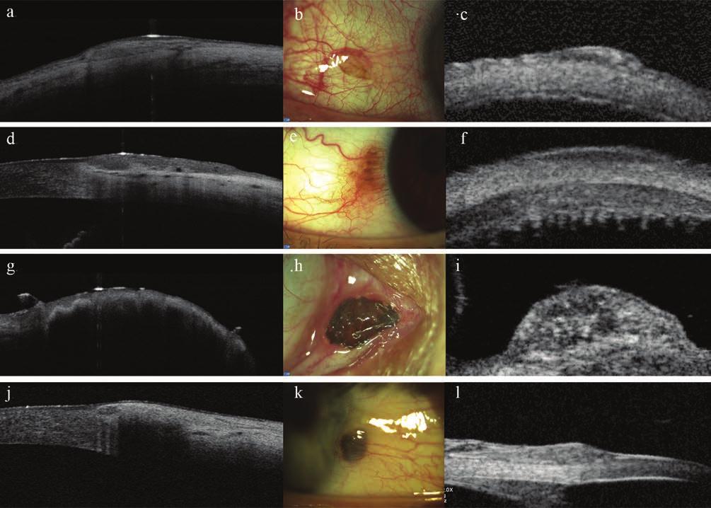 diagnosis of conjunctival nevi 2.