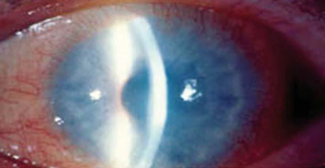 protokoll myopia keratitis astigmatizmus szürkehályog