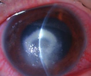 Fungal infection of the cornea A műtét során a recipiens trepanáció méretének kiválasztása során törekedni kell rá, hogy az infiltrá - tumot teljes egészében eltávolítsuk, sőt akörül egy 1-1,5 mm-es