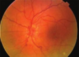1. 24 éves férfi betegünkben rutin szemészeti vizsgálat során derült ki a bal oldali retinalis kapilláris haemangioma.