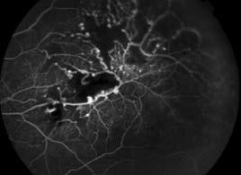 1. táblázat: A retinalis capillaris haemangioma elkülönítő diagnosztikája (folytatás) Kórkép Retinalis cavernosus haemangioma FLAG Vénás fázisban lassú telődés, hyperfluorescens