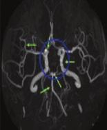 Struge-Weber-szindróma Subretinalis folyadék, exsudatív retinaleválás, írisz-rubeosis, szekunder glaukóma Anti-VEGF, photocoagulatio, PDT Második szemérintettség Általános