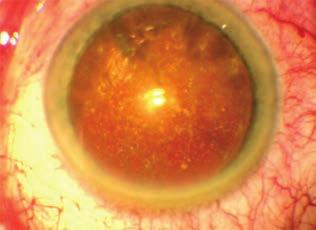 Combined surgery in a patient with cataract and asteroid hyalosis BEVEZETÉS Az üvegtesti homályok okozta úszkáló pontok-foltok látása az egyik leggyakoribb panasz, amivel az idősebb betegek a