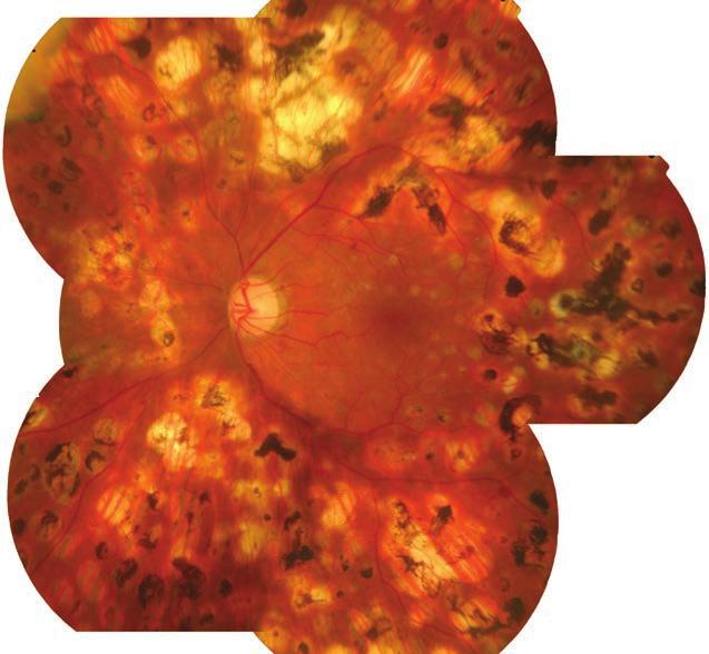 Az ultraszéles látószögű pásztázó oftalmoszkóp összehasonlítása 1. ábra: Egyik vizsgált betegünk szemfenéki felvétele Optomap készülékkel (A), illetve ETDRS 7- mezős standard módszerrel (B).
