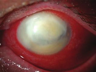 Fungal infection of the cornea 2. ábra: a: Gombás ke - ra ti tis. A hámhiányon túlérő, hátsó stroma - ré te gekre lokalizálódó infiltráció sűrű, a hátlapra húzódó hypo py - onnal. 2. b: a kinagyított részleten apró sza tellit infiltrációk láthatók a) b) nyos gombafajoknál akár barnás is (3.