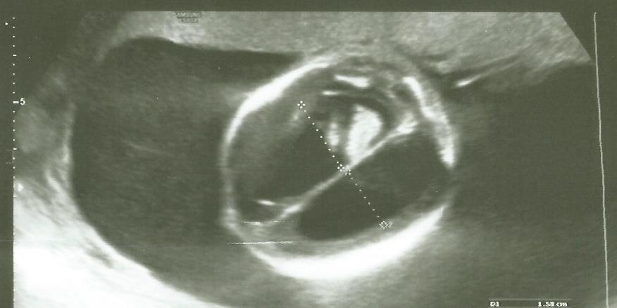 méretének növekedése is kíséri, macrocephaliáról beszélünk. Hydrocephalus externusnak nevezzük a liquor felszaporodását a subarachnoidalis térben.