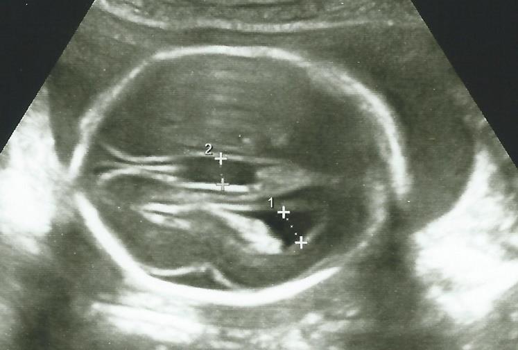 4. ábra Corpus callosum dysgenesia Születési prevalenciája 1:10000-1:15000, de vetélések esetén sokkal gyakoribb.