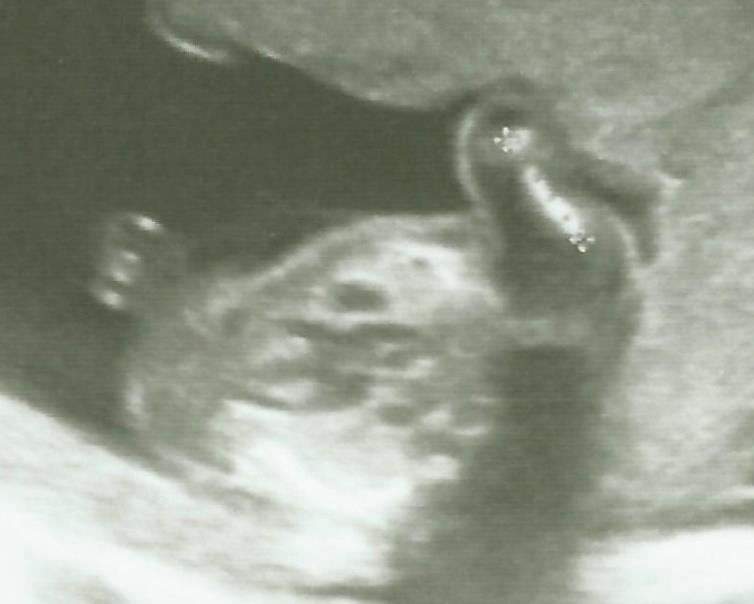 A terhesség során végzett magzati ultrahangvizsgálatok hatékonyságának  vizsgálata a fejlődési rendellenességek felismerésében - PDF Free Download
