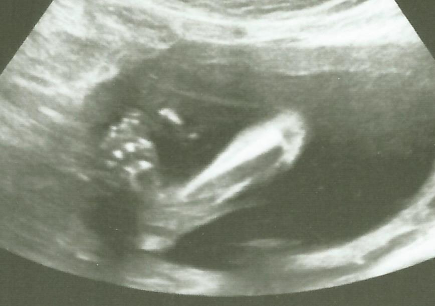 A terhesség során végzett magzati ultrahangvizsgálatok hatékonyságának  vizsgálata a fejlődési rendellenességek felismerésében - PDF Free Download