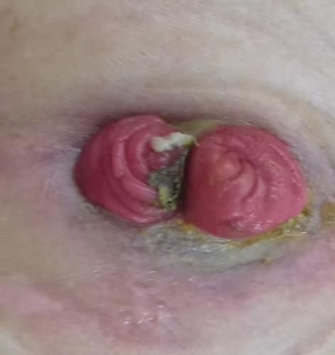 ileostoma M7 Bal oldali