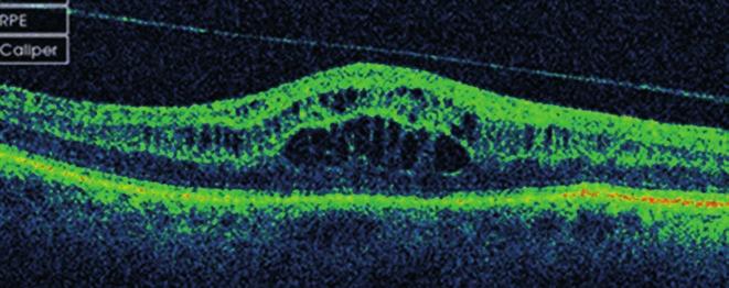 uveitis okozhatott. A betegség kialakulásához vezethet szemet ért sérülés is, preretinális fibrózis vagy nőbetegeknél a menopauzához társuló hormonváltozások.