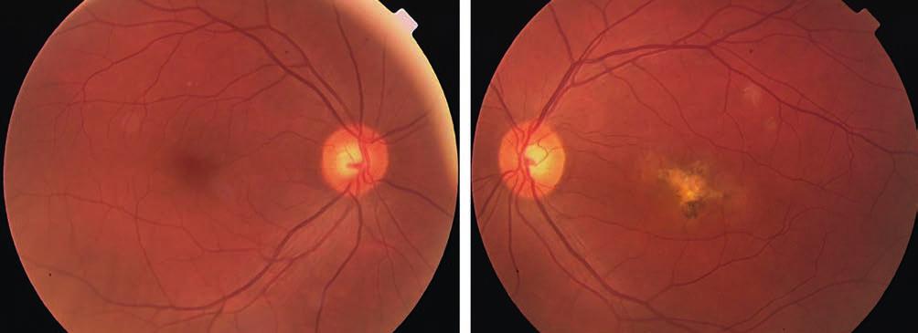 case report of multifocal choroiditis 1. ábra: Szemfenéki kép 2014. márciusban hepatitis) negatív eredményű volt, gyulladásos paraméterek nem mutattak eltérést.