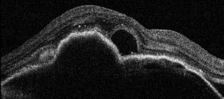 Incidence of rpe tears during anti-vegf therapy of vascularised Ped A PED-eket feloszthatjuk druze - noid, szerózus és vaszkularizált PED-ekre, illetve kevert formákra.