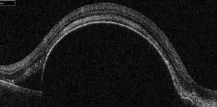 ) 2 intravitreális lucentis injekció után, a Ped magassága nem csökkent, sőt növekedett (1018 µm), az ödéma sem lett kevesebb, ezért áttértünk intravitreális eylea injekció adására 6.