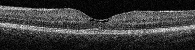 The importance of optical coherence tomography-angiography böztetünk nonproliferatív és szub - retinális érújdonképződéssel járó proliferatív formát.