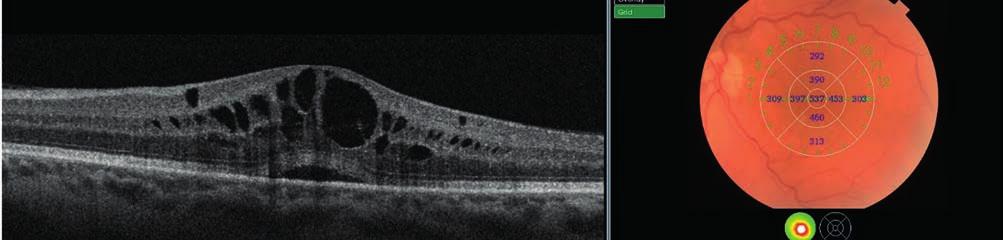 review of the postvaccinal ocular side effects Bevezetés Az alábbiakban ismertetünk egy betegünk esetét, aki a szezonális influenza-védőoltás beadása után pár órával homályos látásra kezdett