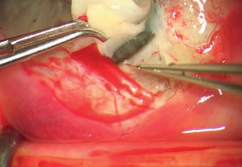 Innovation, safety, efficacy: an update on glaucoma surgery 3. ábra: mély sclerectomia. feltárt Schlemm-csatorna descemeto-tra - becularis ablak. a iuxtacanali cularis trabeculum levonása 4.