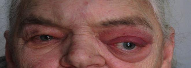extreme-sized sinus frontal osteoma causing exophthalmos amelyek főleg a látást, a hallást és a légzést érinthetik (11, 14, 17).