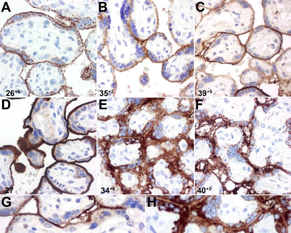 3. ábra. A placentáris syndecan-1 immunfestődés erősebb praeeclampsiában és HELLP szindrómában a kontrollokhoz képest.