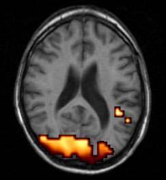 Migrén betegek fmri :