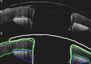 A méréseket RTVue elülső szegment OCT-re is alkalmas spectraldomain készülékkel (Optovue Inc.