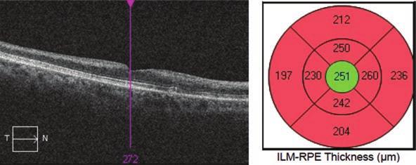 Az ocularis stroke gyakori oka a retina valamelyik artériájának embolizációja. A retinalis artériás elzáródás sürgős szemészeti ellátást igényel.
