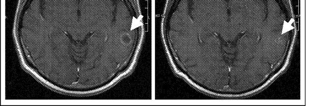 Amplification and mutation of the epidermal growth