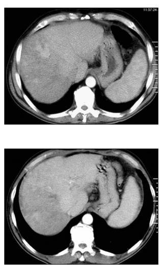 5.ábra : Kontrasztanyagos CT embolizálás előtt (felső kép), Ugyanaz egy hónappal az embolizálás után (alsó kép) Bal lebeny-hypertrophia (Beteganyag [5]) 2.4.6.
