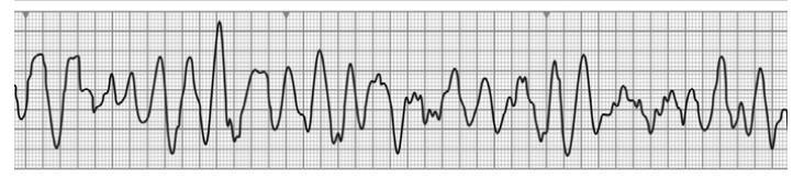 ALS-Sokkolandó ritmus (VF és pnvt) Defibrillálás: bifázisos hullámforma esetén 150 J,