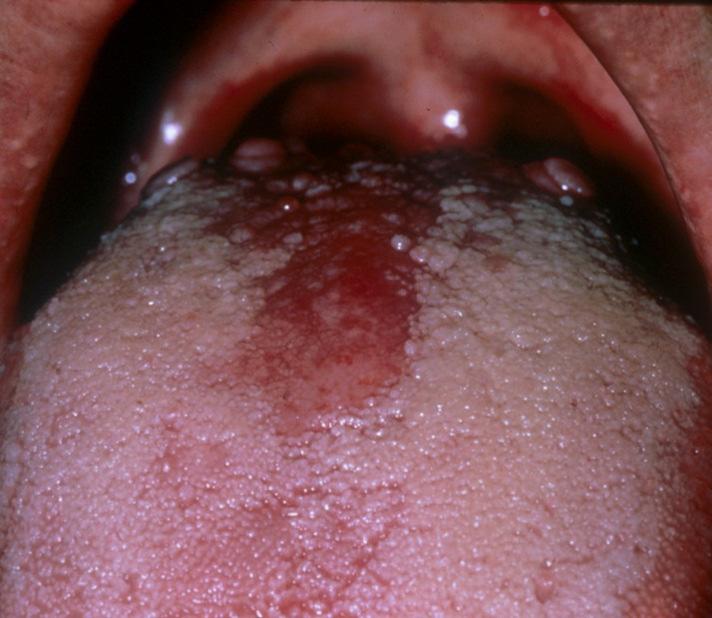 Niacin, nikotinsav, B 3 dehidrogenázok koenzime (NADH) redox folyamatok