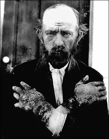 A pellagra bőrtünetei hiperkeratózis, dermatitis, elszíneződés