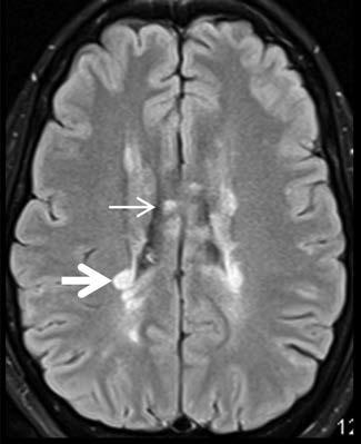 Neuro-ophthalmological emergencies ment Trial-ból (ONTT) (38) levont következtetések szerint, a látási tünetek megjelenésekor az MRI döntő jelentőséggel bír, hiszen a gócok megléte vagy hiánya
