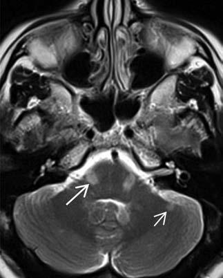 Az olyan betegnél ugyanis, akinél nem volt kimutatható góc, annál a CDMS kialakulásának valószínűsége mindössze 16%, viszont ha az MRI-vel három vagy ennél több laesió mutatható ki, akkor az arány