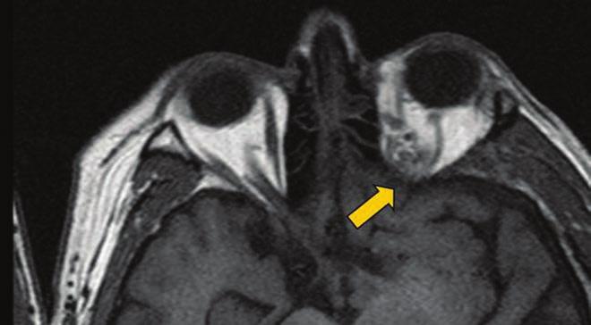 Rhino-orbito-cerebrális mucormycosis 1. ábra: Bal oldalon a m. rectus medialis és a m.