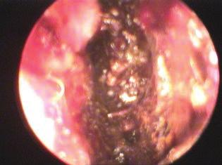 A klinikai kép alapján sinus cavernosus trombózis lehetőségét vetették fel újból. Más - nap ismételten natív és kontrasztanyagos orbita CT-vizsgálatot végeztek, amely változatlan statust igazolt.